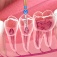 Concept of root canal treatment featuring a tool used to open the canal in the tooth. 