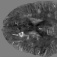 MRI image of brain showing with white arrow location of paramagnetic rim lesion. 